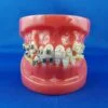 Human Mouth for Orthodontics with Metallic Brackets