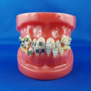 Human Mouth for Orthodontics with Metallic Brackets