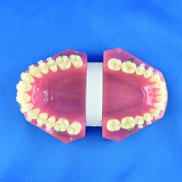 Modello ortodontico dimostrativo completo di occlusore con bracket ceramici