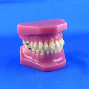 Modello ortodontico dimostrativo completo di occlusore con bracket ceramici