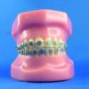 Orthodontic model with ceramic and metal brackets