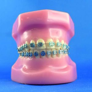 Modello ortodontico dimostrativo completo di occlusore con bracket metallici e ceramici