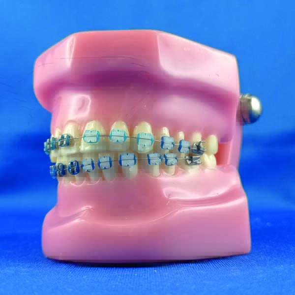 Modello ortodontico dimostrativo completo di occlusore con bracket metallici e ceramici